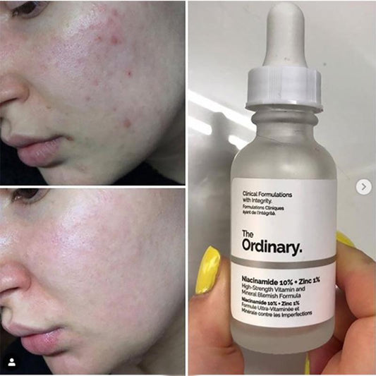 The Ordinary Niacinamide 10% + Zinc 1% High-Strength Vitamin & Mineral Blemish Formula | Reduces Dark Spots, Minimizes Pores & Balances Sebum for Clear Skin